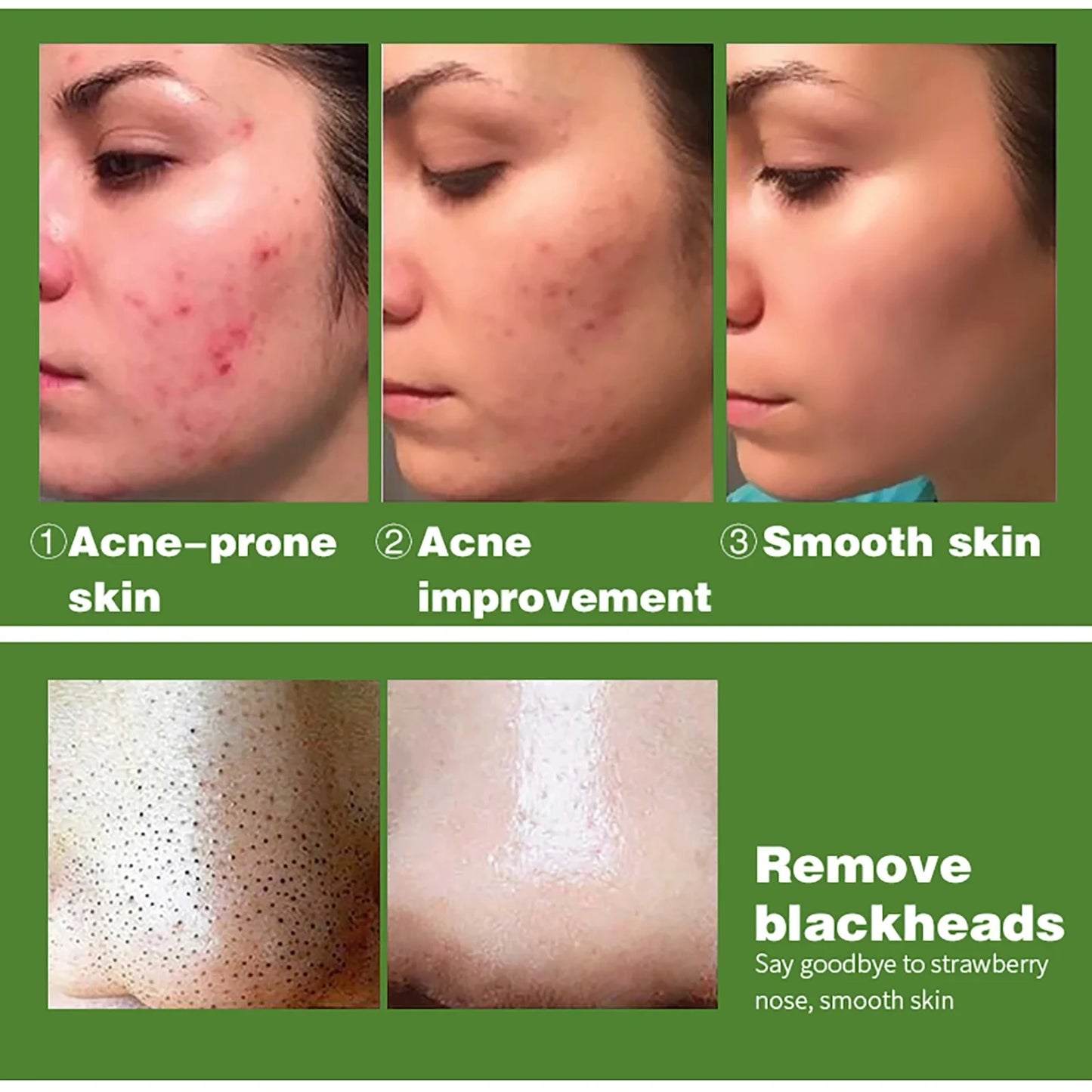AILKE Organic Anti Acne Cleansing Set For All Skin Types